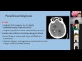 understanding gliomas neurosurgical tv