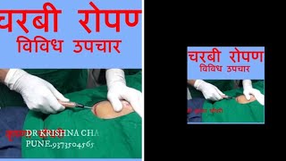 FAT GRAFTING LARGE VOLUME  फैट  रोपण  मोठ्या प्रमाणावर