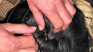 New hair  wig ingrown hairs asmr | ingrown 10 ingrown