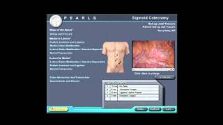 SAGES Pearls Session: Laparoscopic Sigmoid Colectomy Introduction - Peter Marcello