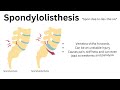 spondylolysis vs spondylolisthesis definitions diagrams and radiographic appearances