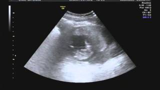 妊娠13週 Baby13week Ultrasonography Echo Video pregnancy ベビちゃんねる001 もっちゃん動画