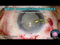 CataractCoach™ 2283: white cataract sutureless MSICS