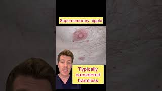 Part 2: SUPERNUMERARY NIPPLE AKA THIRD NIPPLE EXPLAINED #shorts #medical #doctor #health