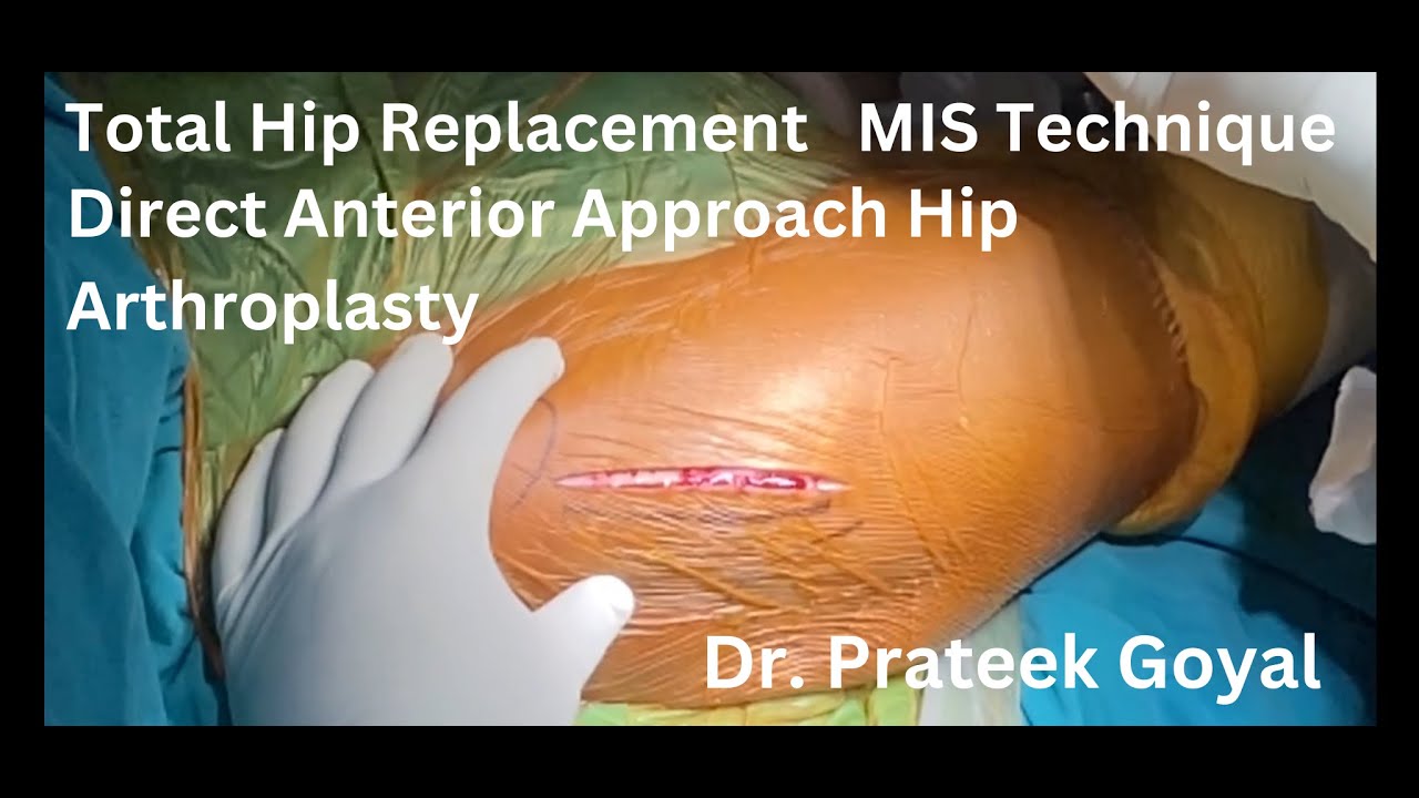 Total Hip Replacement Mis Technique Direct Anterior Approach Hip