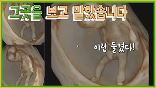 [임신 12주 4일]  성별 확인 및 기형아 검사 (아들입니다)