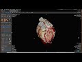 vitrea training tutorial on how to evaluate a coronary ct angiogram