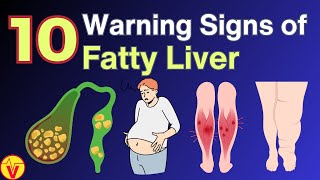 10 Signs and Symptoms of Fatty Liver Disease | Non Alcoholic Fatty Liver Disease | VisitJoy