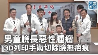 男童臉長惡性腫瘤 3D列印手術切除臉無疤痕