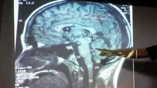 Resonancia Magnética Cerebral, Corte Sagital