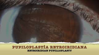 Retroiridian Pupilloplasty / Creating a pupil.