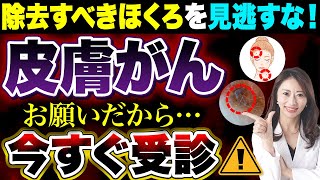 【 皮膚がん の見分け方】こんな「 ほくろ 」の症状があったら絶対見逃さないで！ 皮膚癌 の 初期症状 について皮膚科医が解説