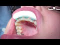 braces bite turbos tooth time family dentistry new braunfels texas