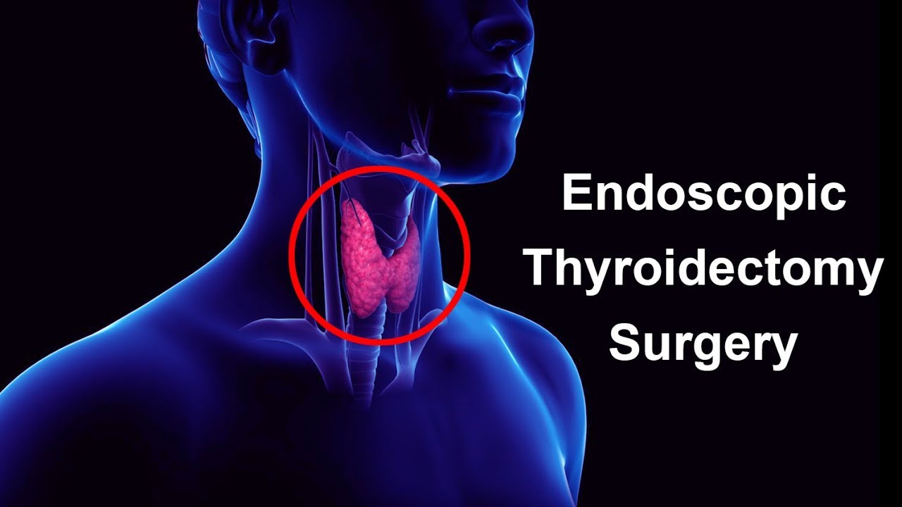 Thyroidectomy | Thyroid Gland | Thyroid Cancer | Thyroid Surgery ...