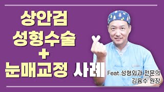 셀라성형외과★ 상안검성형수술+눈매교정 실제사례와 함께 보기!