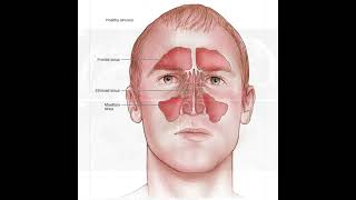 Acute Sinusitis Symptoms and Causes - Diagnosis - Treatment - Prevention #healthcare