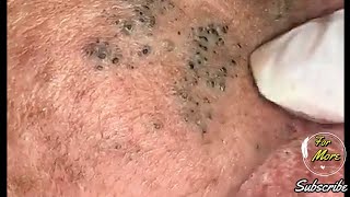 Dr Pop -  Deep Blackheads in old Skin removing \u0026 treatment 2020 (Part 4) HD