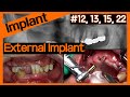 [Online Surgery] OneGuide surgery with SS implant