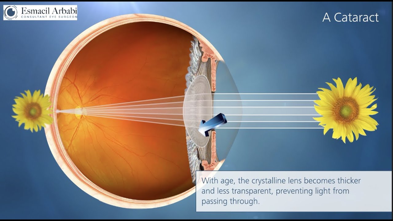 What Is Cataract Animation High Quality Video Youtube