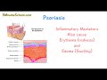 what is psoriasis definition etiology classification pathophysiology diagnosis treatment