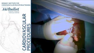 Central Vein Balloon Angioplasty (Maham Rahimi, MD, Kaled Diab, MD, and Mariah Thomas, PA-C)