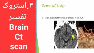 3.بخش سوم آموزش تفسیر سی تی اسکن مغز #Brain_Ct_scan_interpretation خانم دکتر مهاجر