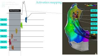 Activation Mapping Idiopathic VT - EP in Practice sample