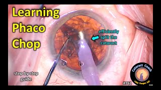 Learning Phaco Chop Cataract Surgery - you can do it!