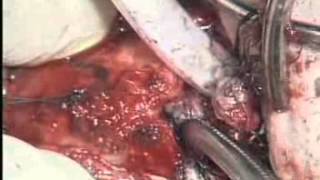 Open Extraction of Incorporated Tracheal Stent