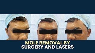 Mole Removal with Surgery \u0026 Laser | Expert Treatment by Dr. Guru Karna Vemula at Personiks