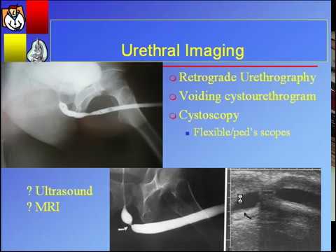 Urethral Stricture Disease: Contemporary Management - YouTube