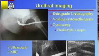 Urethral Stricture Disease: Contemporary Management
