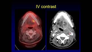 Optimizing PETCT Protocols in the Head and Neck