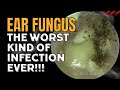 EAR FUNGUS - The Worst Kind Of Infection EVER!!!