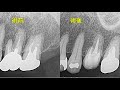 精密根管治療 　【愛知県刈谷市の歯医者】　再根管治療　１回で終わる　one visit root canal therapy　バイオセラミックス　自由診療　顕微鏡歯科　マイクロスコープ　kariya