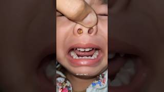 Stuck In Nose 😵  | How Doctor Remove | #shorts #viral #trending #GOLIVEFACT