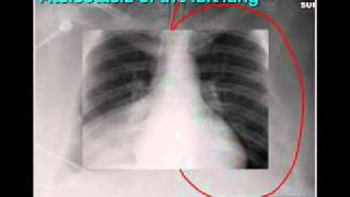 LearningRadiology 02 (Sihouette Signs)