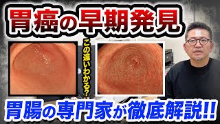 胃がんの早期発見には胃カメラで差がつく⁉️胃を切除しないためにもこの話を聞いてみてください…　教えて久津川先生 No223