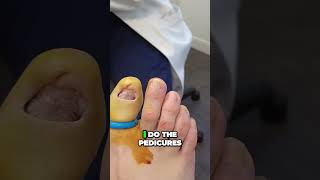 Cauterizing a toenail