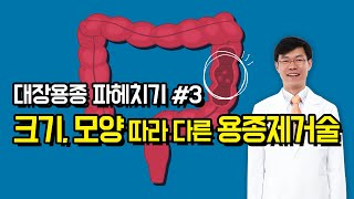 대장용종 파헤치기 마지막! - 크기, 모양 따라 달라지는 용종제거술