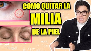 Como Quitar La Milia De La Piel ¿Porque Sale?