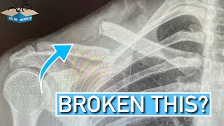 Broken your Clavicle? Here is what to do (collar bone)