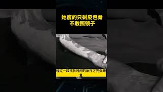 她瘦的只剩皮包骨，不敢照镜子 #shorts #奇闻趣事 #奇闻 #科普