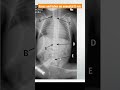 Lines and tubes on neonatal X-ray #neonatalradiology #X-ray #lineposition