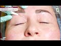 Мезотерапія періорбітальної зони dermaheal sr💚. Папульна техніка