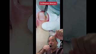 SUPER ANGRY INGROWN TOENAIL WITH ABSCESS😢#shorts #ingrown_toenail