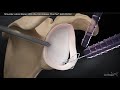 Shoulder Labral Repair With the 1.8 Knotless FiberTak® Soft Anchor