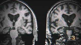 Previously unknown long term symptoms for some patients with traumatic brain injuries