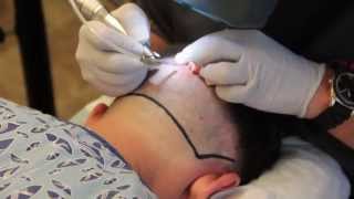 Neograft hair transplant procedure in Boise - Silk Touch Med Spa