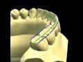 MANDIBLE - OCCLUSION